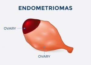 endometrioma