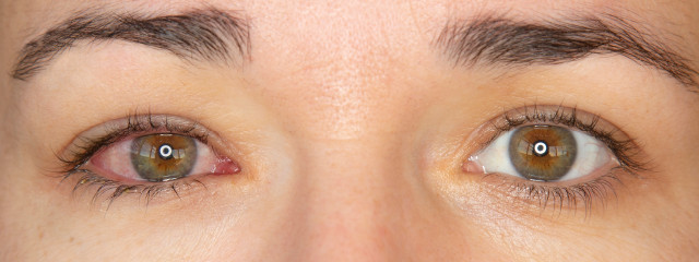 What is Commonly Misdiagnosed as Pink Eye?