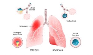 A graphic of the lungs