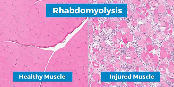 rhabdomyolysis