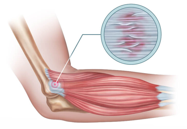 a drawing of an elbow with the tendons highlighted