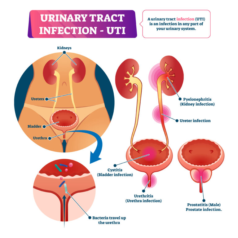 Urinary tract infection or UTI vector illustration. Labeled medical disease scheme with inner organs structure diagram. Educational bladder system illness and problem list. Kidney disorder infographic