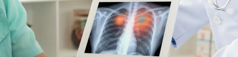 A close-up of a chest x-ray showing lung cancer in an emergency room in Houston, TX.