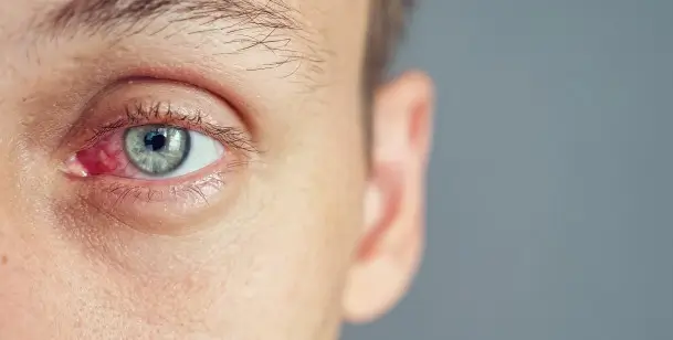 Close up of a person's red eye in Houston, TX