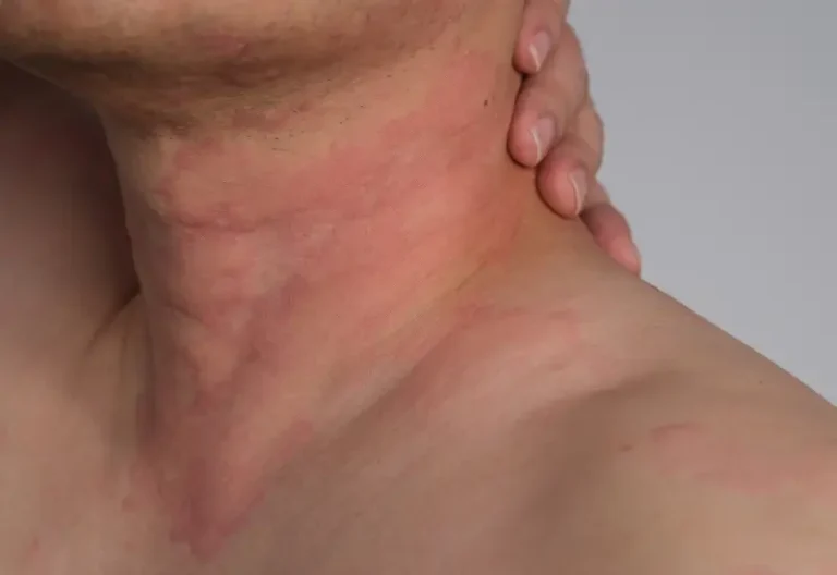 A man having an allergic reaction shows his neck at an emergency room in Houston, TX